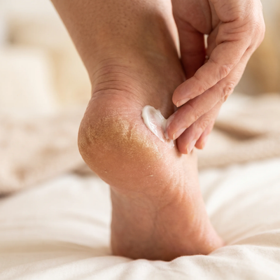 It Softens The Callus First